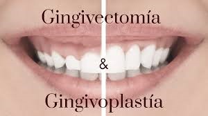Gingivectomia